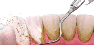 sarro dental causas
