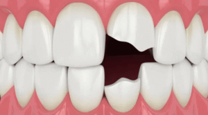 paciente revisando un diente roto en clínica dental