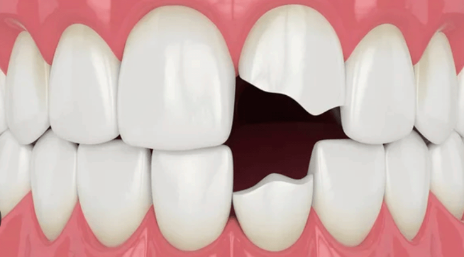 paciente revisando un diente roto en clínica dental
