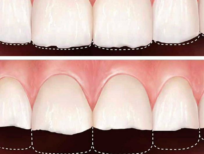 persona-observando-desgaste-dental-en-dientes-delanteros